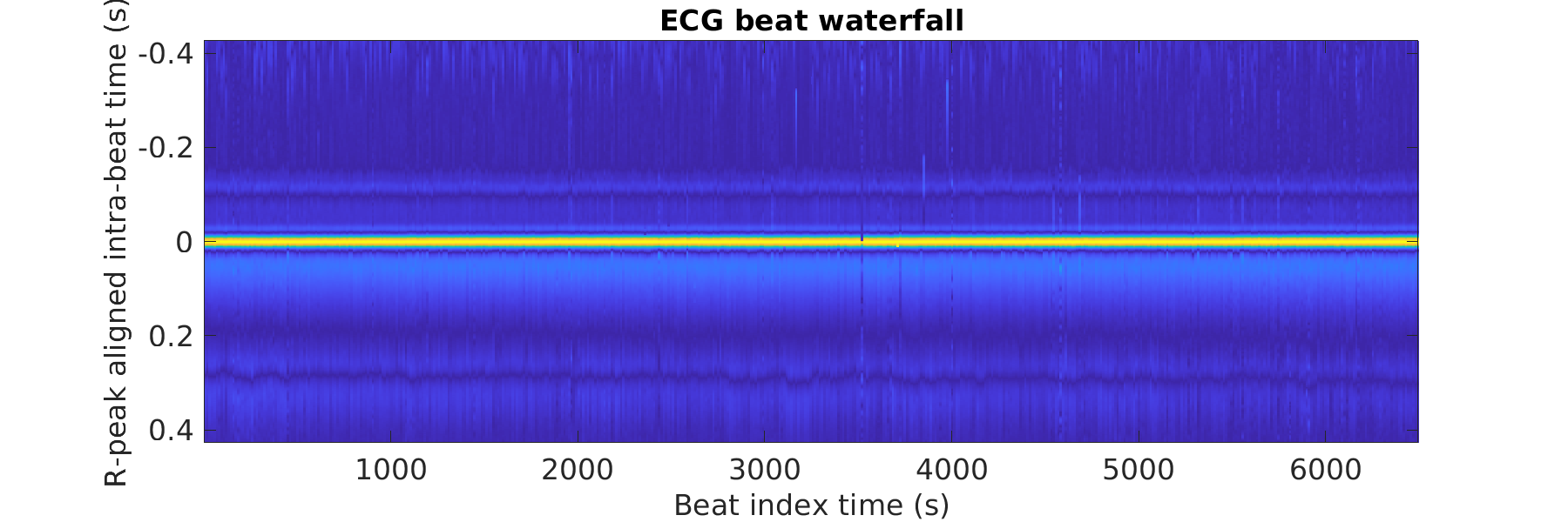 S008_ecg_beats_waterfall