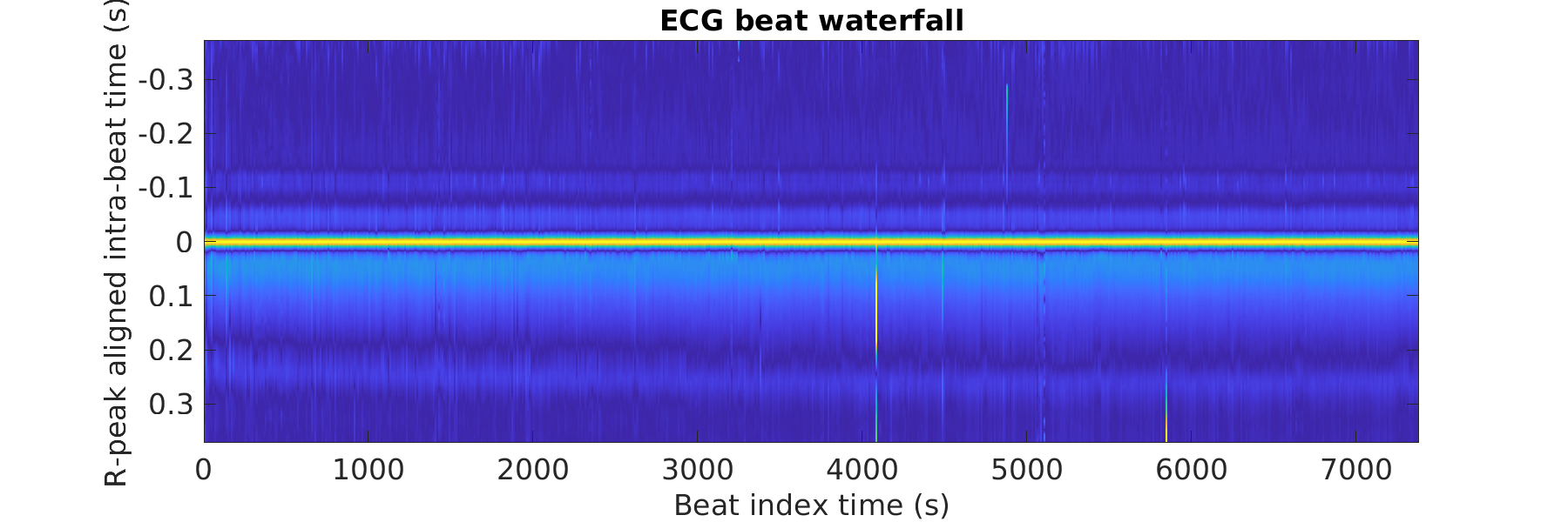 S010_ecg_beats_waterfall