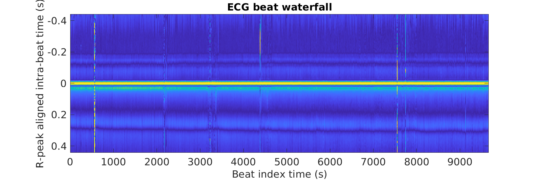 S020_ecg_beats_waterfall