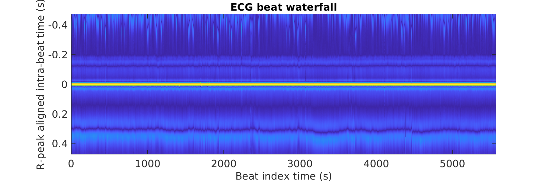 S022_ecg_beats_waterfall