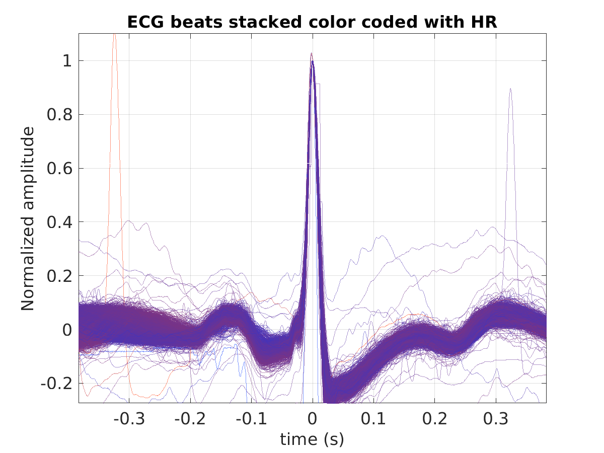 S025_ecg_stacked_colorcoded_hr