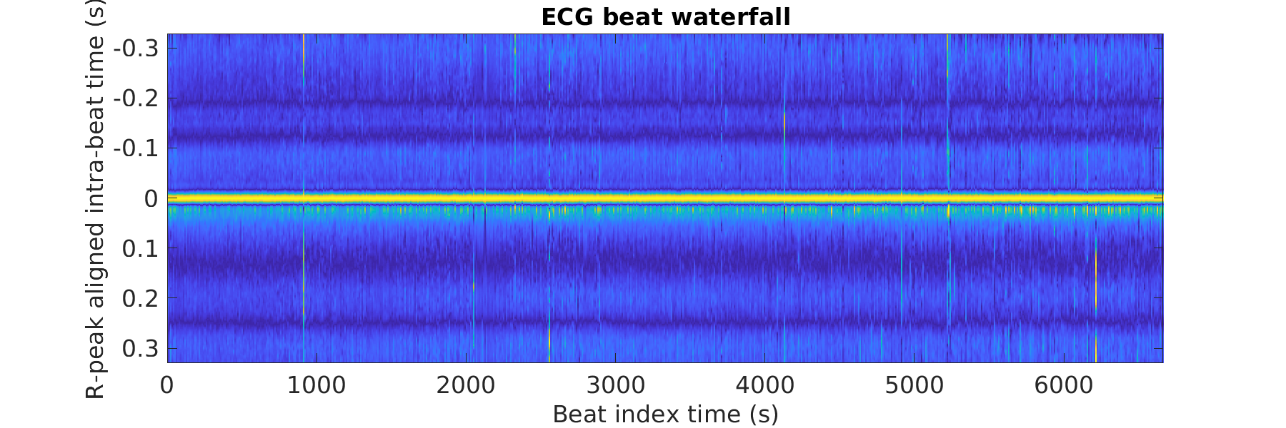 S026_ecg_beats_waterfall