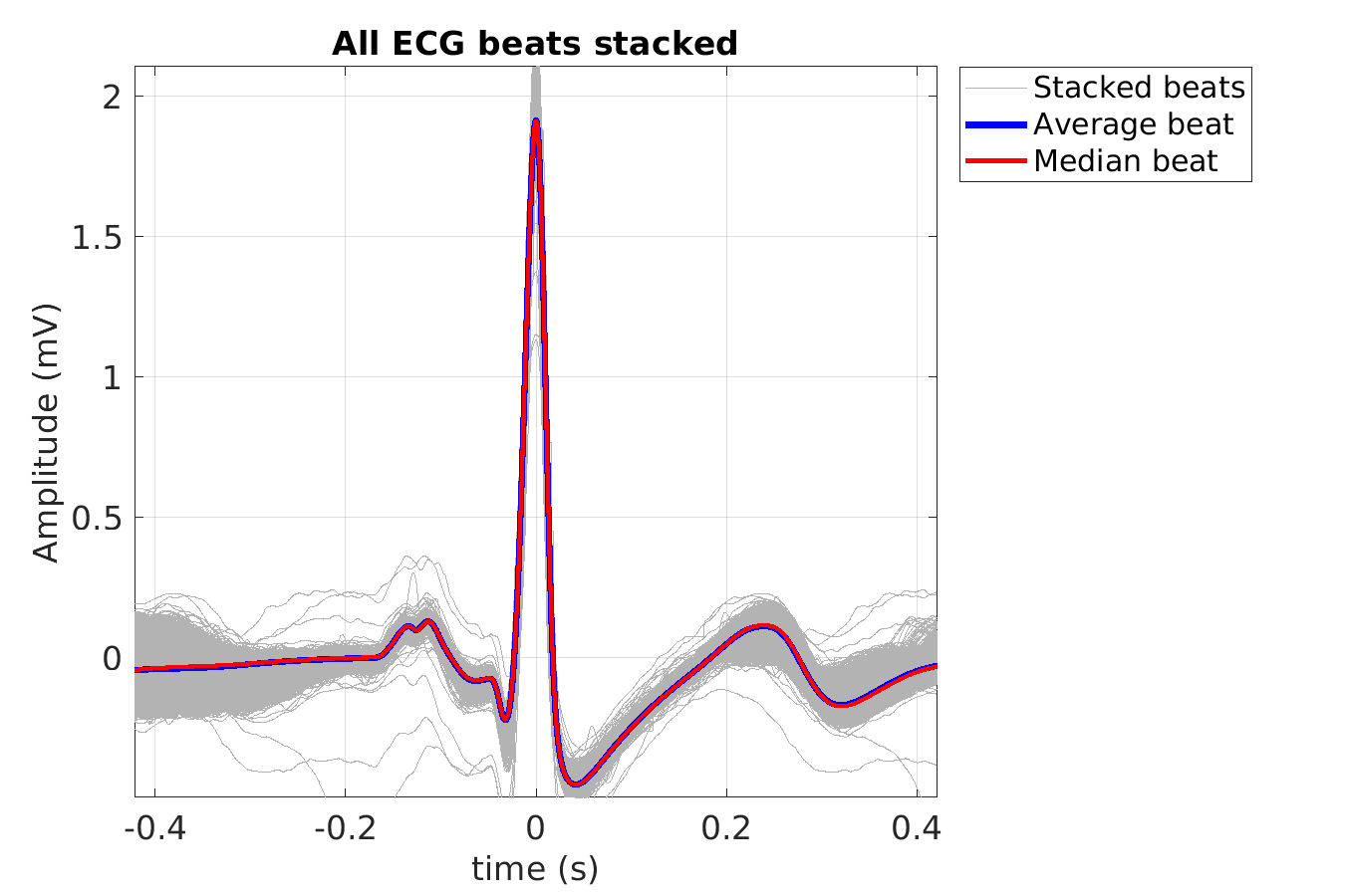 S043_ecg_beats_stacked