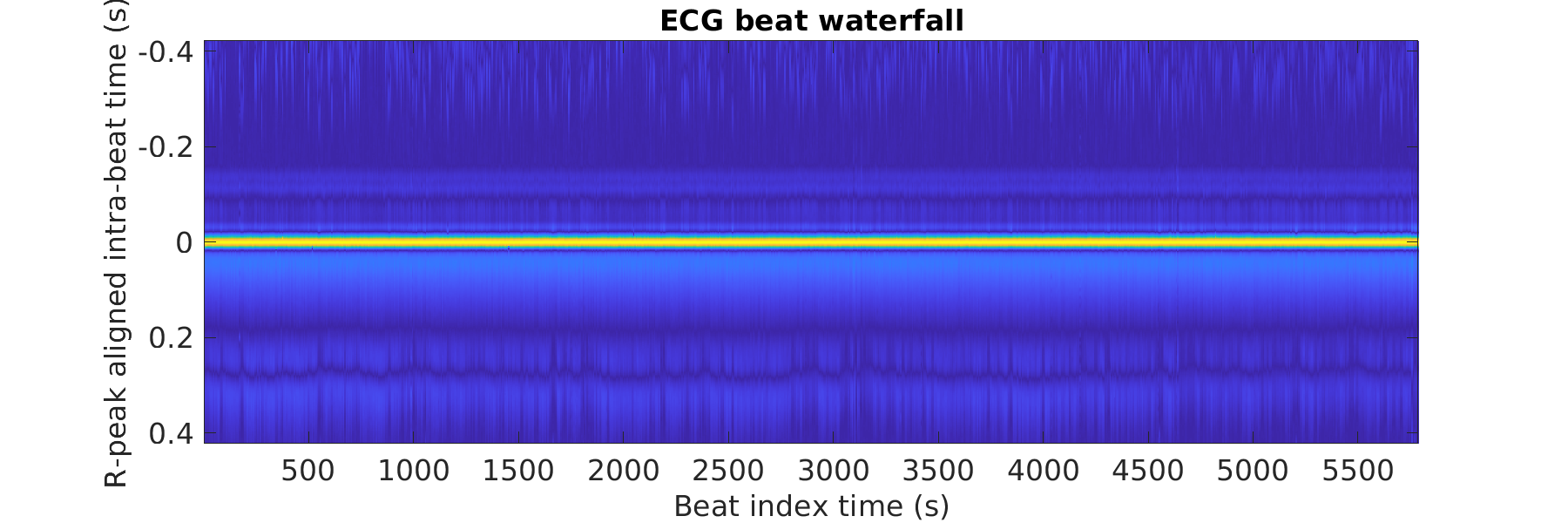 S043_ecg_beats_waterfall